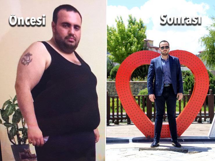 Sivasta 31 yaşındaki Engin Albayrak tüp mide ameliyatıyla 1.5 yılda 76 kilo verdi