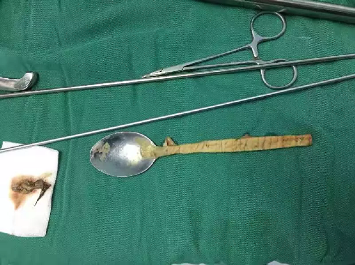 Çinde bir adamın boğazından 20 santimlik kaşık çıkarıldı