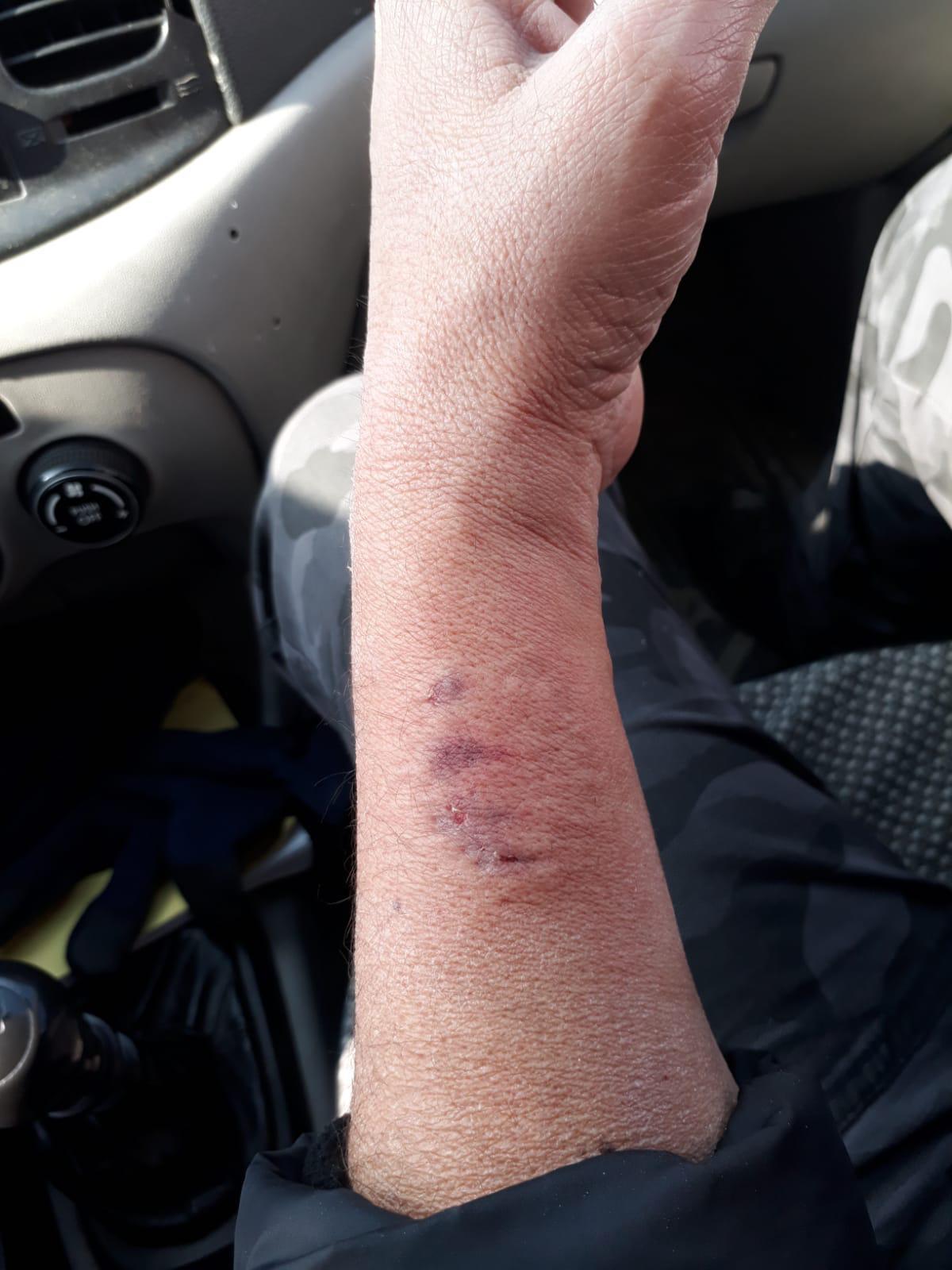 HDPli vekil polis memurunun kolunu ısırdı
