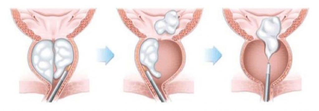 HoLEP prostat ameliyatı nedir, nasıl yapılır