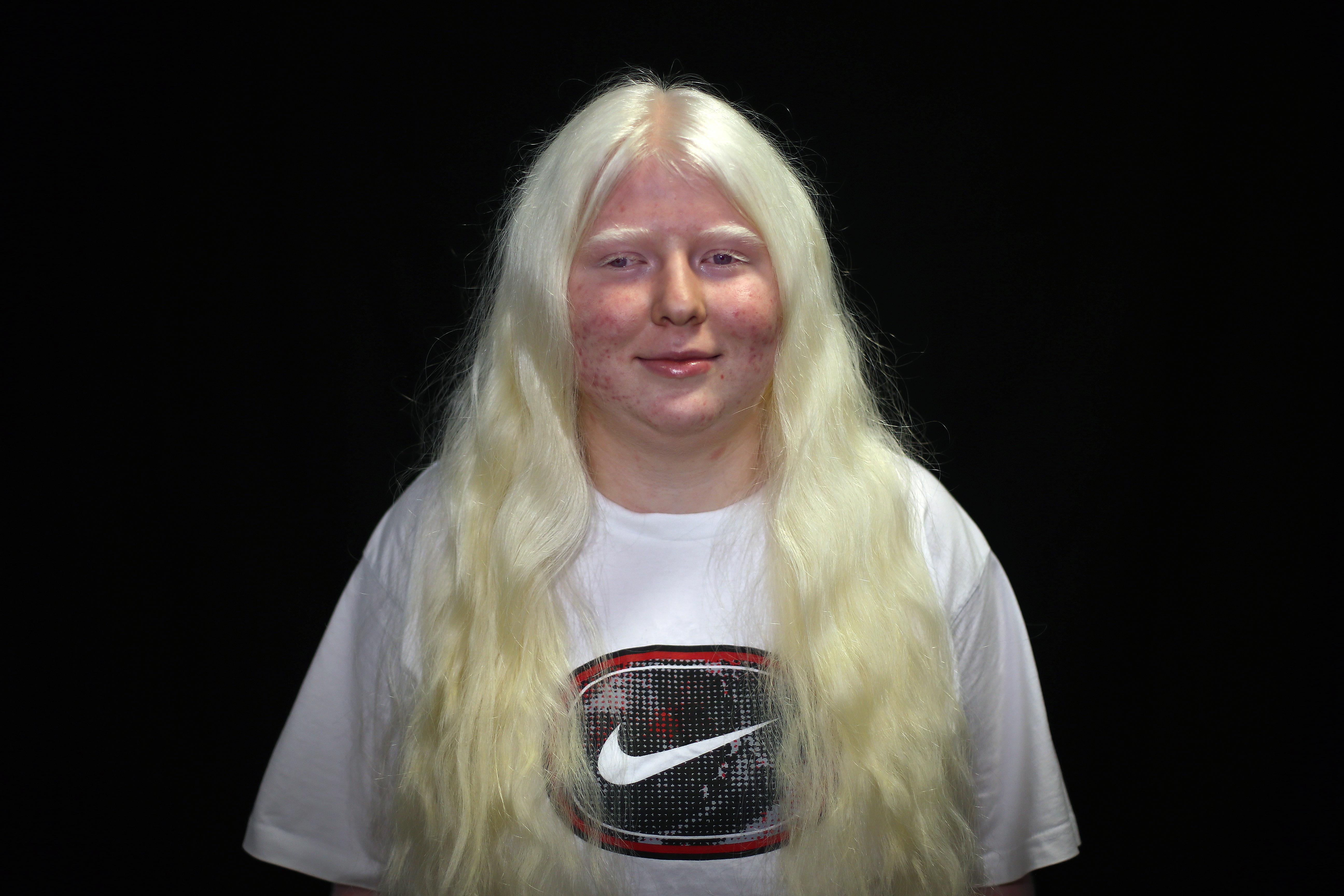 Çukurovanın sıcağında albino olmak
