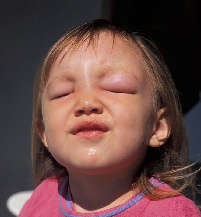Dünyada gıda alerjileri neden artıyor Besin alerjileri çocukları nasıl etkiliyor