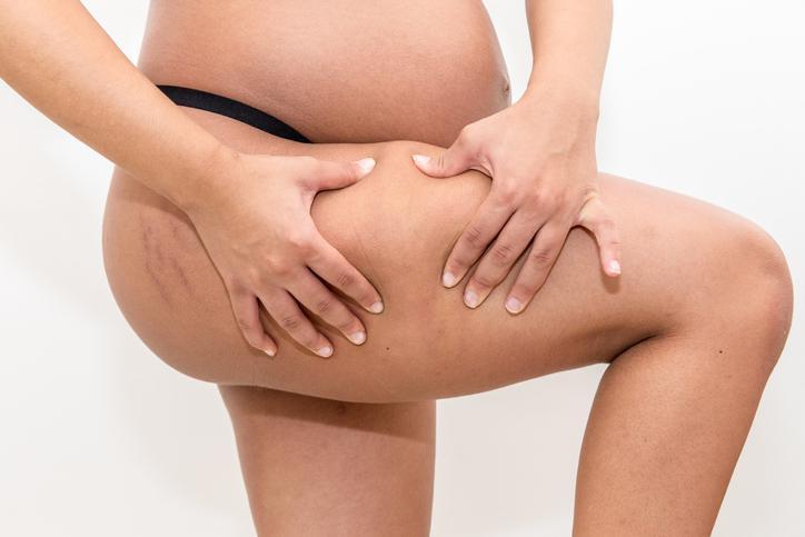 Hamilelik vücut şeklini nasıl değiştiriyor Hamilelik çatlakları nasıl önlenir