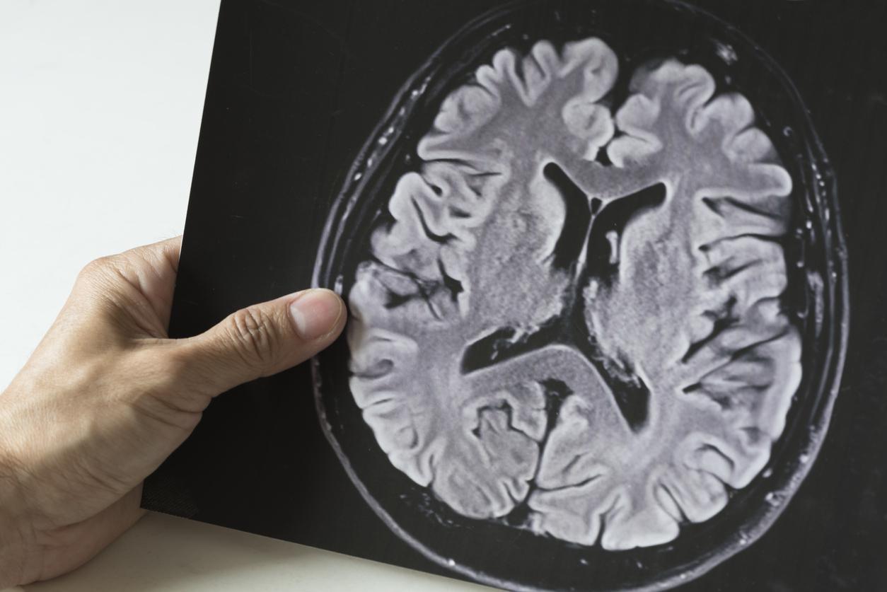 Beyin tümörünün belirtileri nelerdir