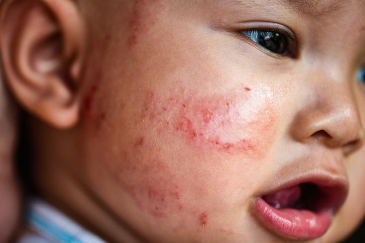 Bebeklerde ve çocuklarda besin alerjisi belirtileri nelerdir