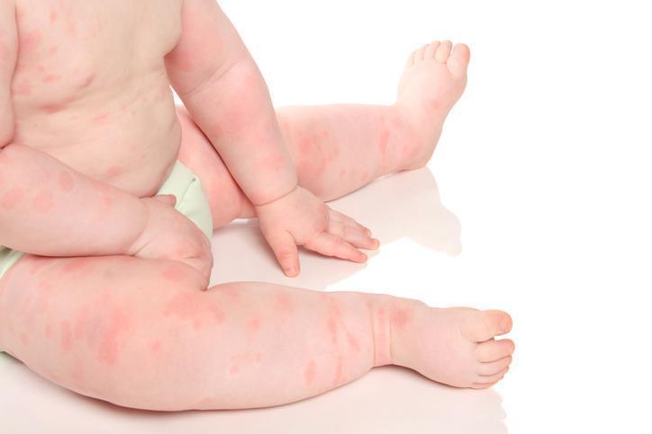 Bebeklerde ve çocuklarda besin alerjisi belirtileri nelerdir