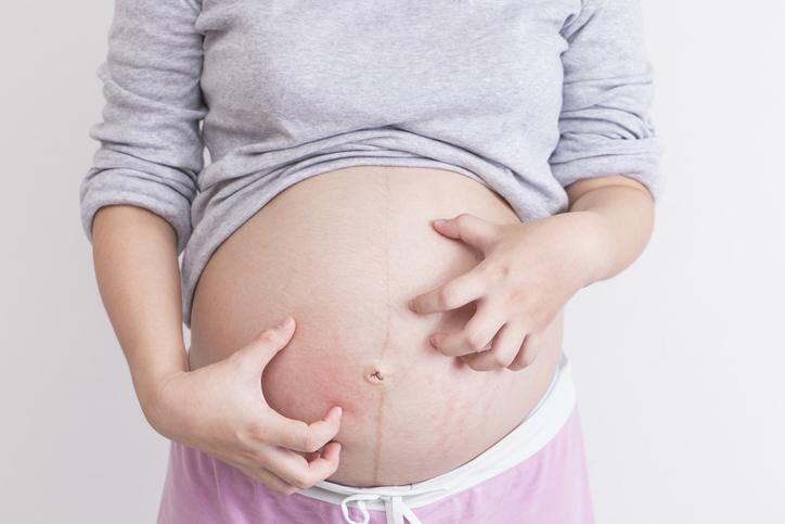 Hamilelikteki kaşıntıların nedeni gebelik sarılığı olabilir