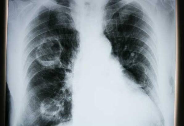Akciğer kanseri hastalarının ömrü uzuyor