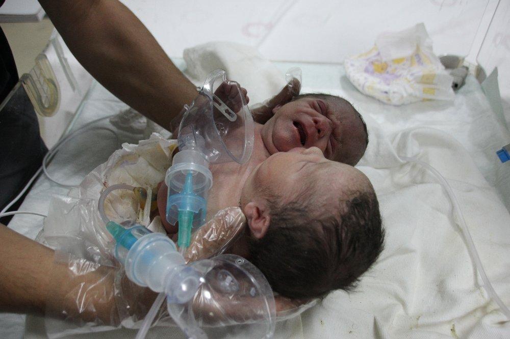 Suriye’de çift başlı bebek dünyaya geldi