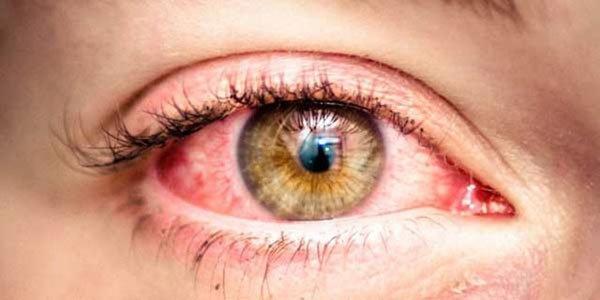 Aman dikkat Gözlerinizdeki kızarlık tehlikeli olabilir (Konjonktivit nedir)
