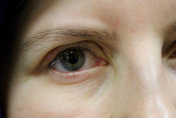 Göz kapağını kapatamayan hastalar için altın implant