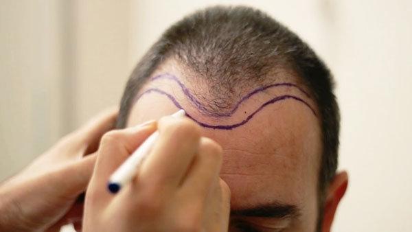 Doğal sonuçlar için saç çizgisi önemli (Saç ekimi hakkında her şey)