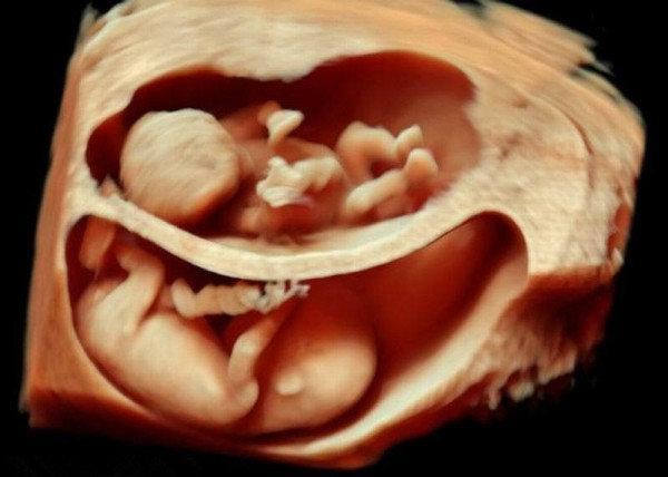 Tüp bebek çoğul gebelikleri artırdı (Çoğul gebelikte normal doğum mümkün mü)