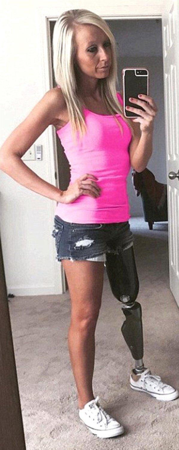 ABDde bir kadın mini etek giyebilmek için sağ bacağını kestirdi