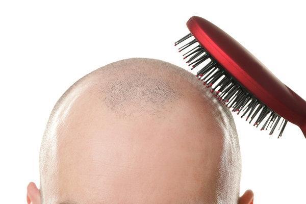Saç ekimi yaptırırken saçlarınızdan olmayın İşte riskler ve bilinmeyenler