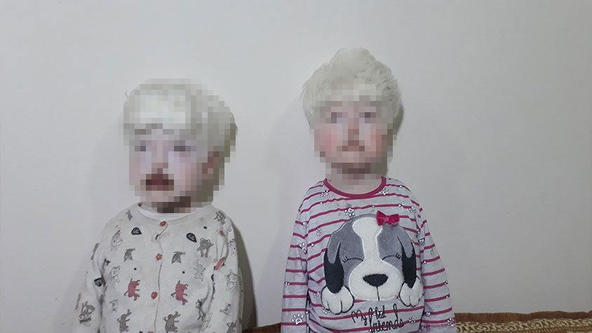 Mardinde yaşayan albino hastası kardeşler yardım bekliyor