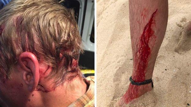 ABDli adam yılan, ayı ve köpek balığı saldırılarından kurtuldu