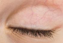 Sol göz kapağı seğirmesi neden olur, nasıl geçer? Nörolojik nedenleri nelerdir?