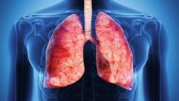 Bronşektazi hastalığı nedir? Bronşektazinin belirtileri nelerdir?