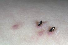 Arı-böcek-sivrisinek sokmalarına karşı alınabilecek 10 önlem