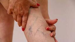 Varisin belirtilerine dikkat! Bacakta şişlik ve his değişikliğini ciddiye alın: Uzmanı tek tek uyardı