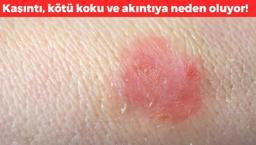 Kaşıntıyla ortaya çıkıyor! Vajina ve ayaklarda görülüyor: Keskin koku ve akıntıya neden oluyor