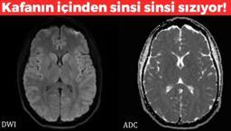 Türk profesörün araştırmasında korkutan sonuç! Kafanın içinden 'gizli sinsice sızıyor