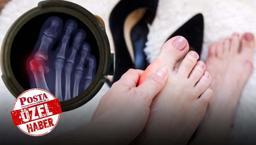 Güzelliğin bedelini ağır ödetiyor! Uzmanı uyardı: Nasır, tırnak batığı ve şekil bozukluklarına neden oluyor!