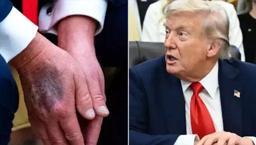 Sebebi ortaya çıktı! Trump elindeki morlukların neden oluştuğunu açıkladı