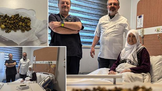 77 yaşındaki kadının safra kesesinden 213 taş çıktı! 5 aydır karın ağrısı yaşıyordu)