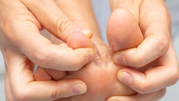 Ayak mantarının kökünü kurutuyor! Her evde var, 1 parça kullanmak yetiyor! 15 dakika uygulayın)