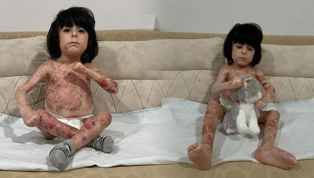 Vücudunu kaplayan yaralar yüzünden kıyafet giyemiyor! 4 yaşındaki İbrahim'in yürek yakan çaresizliği)