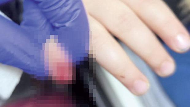 Yürüyen merdiven parmağını kopardı)