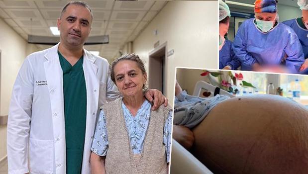 Kabızlık şişkinliği sandı, karnından tam 22 kilo tümör çıktı! Ameliyattan önce 79 kilo olan kadın 57'ye kadar düştü)
