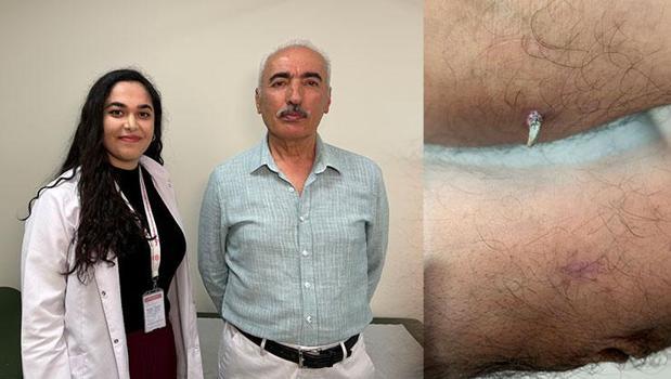 Dirseğinde küçük bir yara sandı… Gerçek bambaşka çıktı: 'Geçmeyen yaraları ihmal etmeyin')