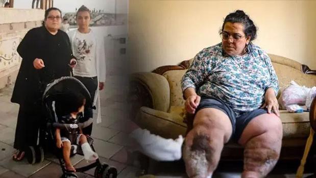 Fil hastalığıyla yaşam savaşı! 3 çocuk annesi Fatma: 'Yaralarda kurtlanma oluşuyor')