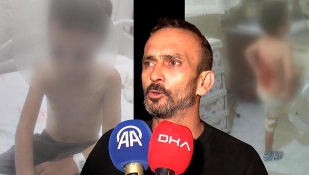 12 yaşındaki Batuhan’ı arkadaşları kolonya ile yaktı! 'Biri çocuğu tutarken diğeri döküyor')