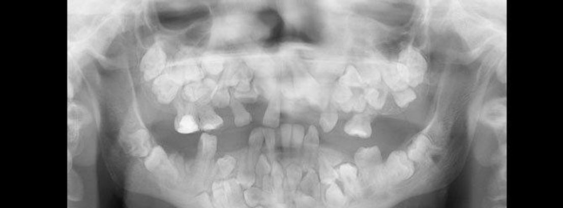 85 di&#x15F;li adam&#x131;n 58 di&#x15F;i &#xE7;ekildi!