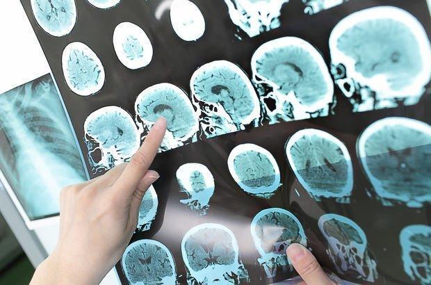 Tedavi edilmeyen grip felç ediyor