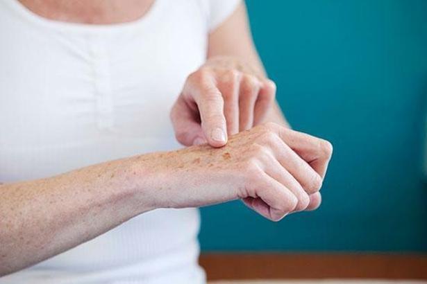 Yaşlanma lekelerine dikkat! Cilt lekeleri nasıl geçer?