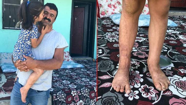 Derisi sertleştiği için yürüyemiyor! 'Anne bu ayaklarım neden böyle oldu?'