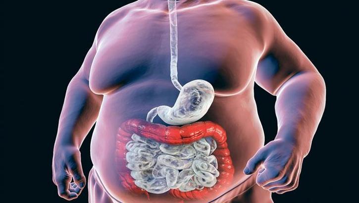 Obezite 32 kanser türüyle bağlantılı