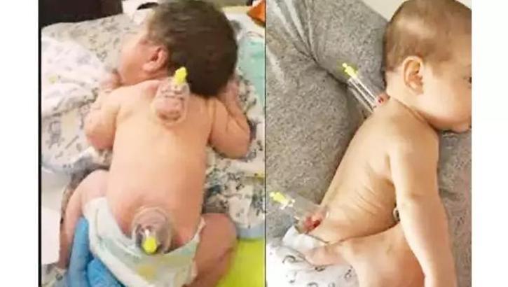 Küçücük bebeklere hacamat yaptırıyorlar! Aman dikkat: Büyük bir riski var