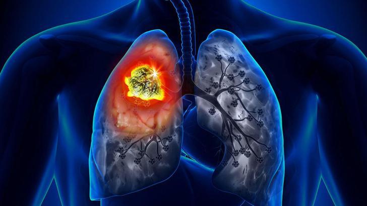 KOAH tedavisinde ilk adım oymuş! Tütün ve mamullere dikkat