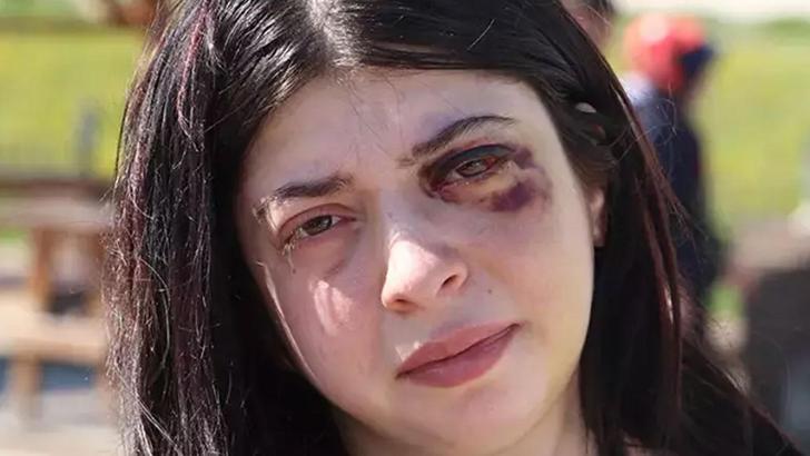 Taciz edildi, sokak ortasında dövüldü: 3 ay sıvı ile besleneceğim