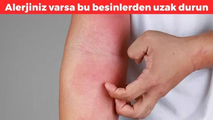 Doğru beslenme ile alerji mevsimini rahat atlatabilirsiniz! Bu basit besinlere dikkat etmek yetiyor, gün içerisinde mutlaka uygulayın