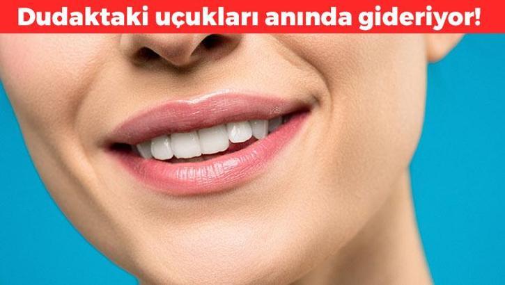 Uçuk çıkınca hemen bu karışımı sürün! Dudakta iz bırakmadan kurutuyor