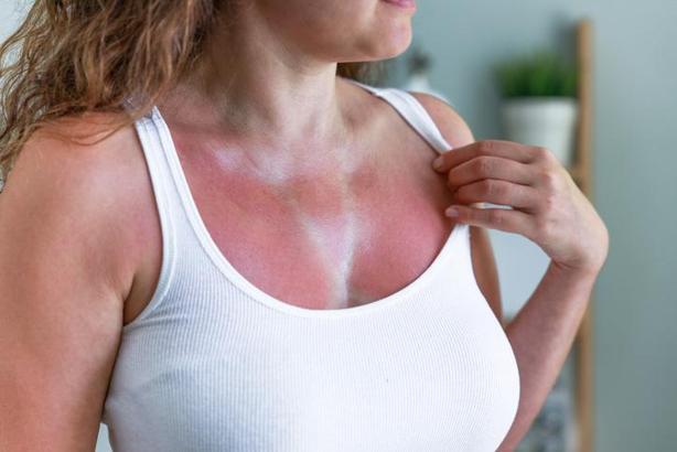 Güneş yanığına ilk müdahaleye dikkat! Dermatologdan hayat kurtaran uyarılar
