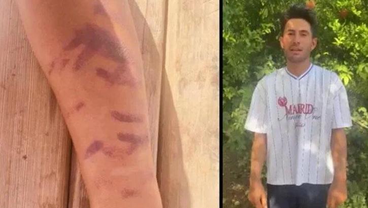 Lazer epilasyon 23 yaşındaki adamın kabusu oldu! Ben yandım başkaları yanmasın diye isyan etti