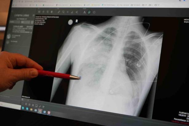 Uzmanı uyardı: "Zatürre ölümünüze neden olabilir"